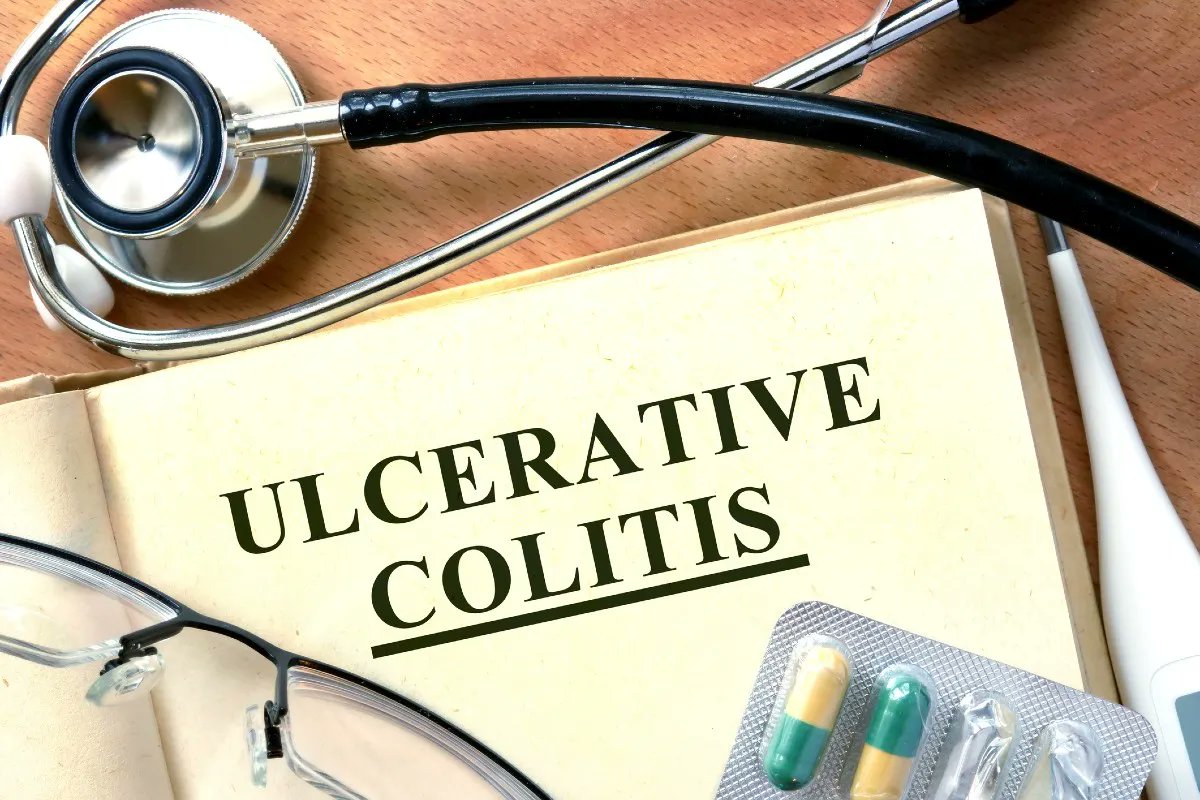 Some people with moderately to severely active ulcerative colitis are set to benefit from a new treatment if they don't respond to conventional therapies in final draft guidance published today by NICE: bit.ly/3s194s9