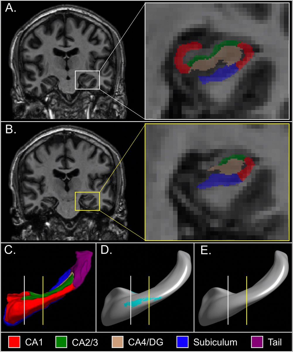 MaxwellJRoeske's tweet photo. ... eliminated clusters in the anterolateral hippocampus consisting primarily of the CA1 subfield, an area implicated in schizophrenia pathology. These data suggest that hippocampal structural differences can be attributed to an anatomic variant arising during development.

6/7 https://t.co/Iklp0MdO0E
