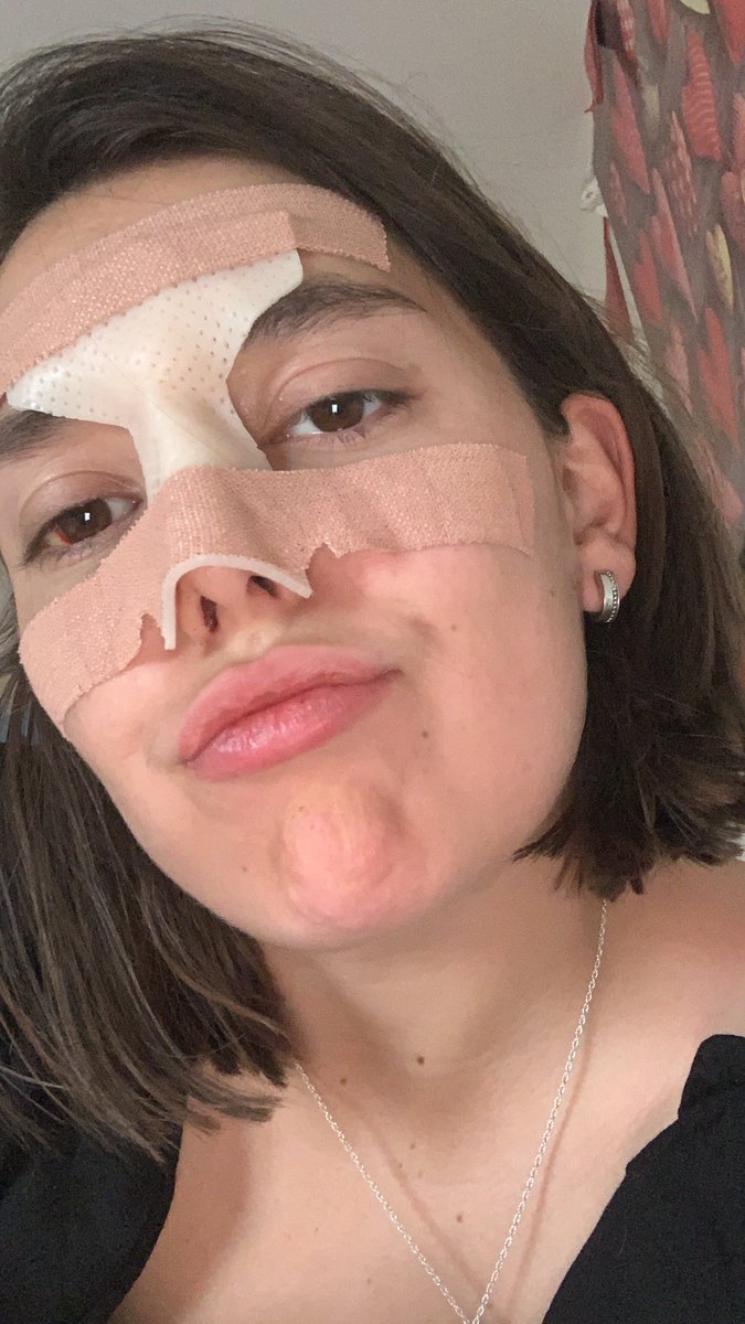 Post op feels