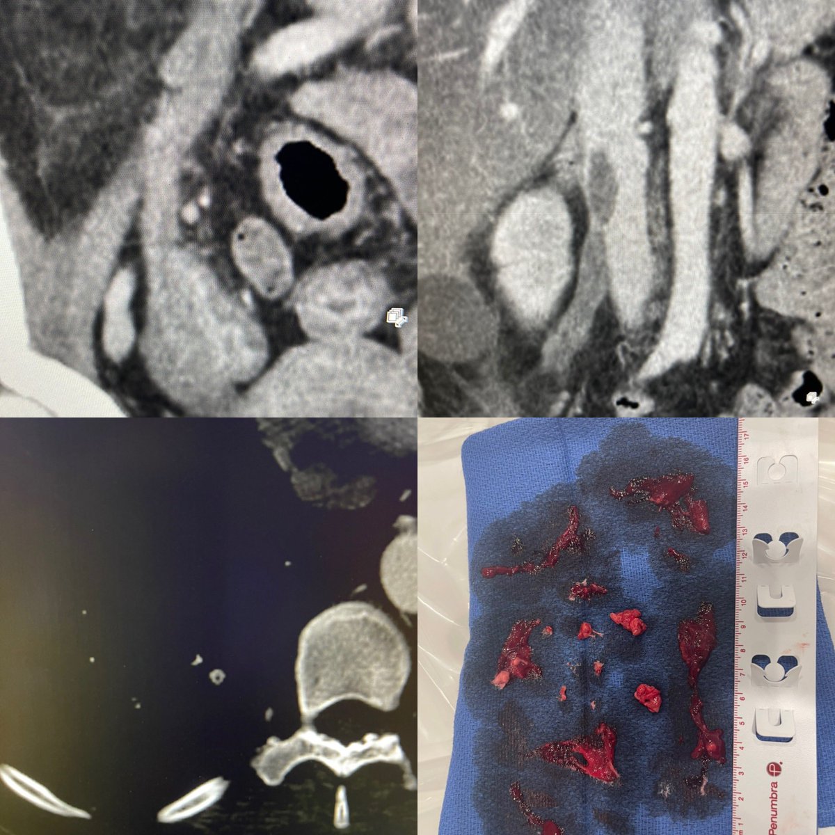Saud Ahmed (@saudsahmedmd) on Twitter photo Bizarre #irad case where the ovarian vein thrombosed from colitis, protruding into the IVC + PE. No AC due to GI bleeding. Combo of IVUS and <a href="/PenVascular/">Penumbra Vascular</a> Lightning 12 got the bugger out.
We (<a href="/shamitsdesai/">Shamit Desai MD</a>) do see crazy stuff in #privademics!
<a href="/linemonkeymd/">Line Monkey MD</a> <a href="/_backtable/">BackTable Vascular and Interventional</a> <a href="/SIRRFS/">SIR RFS</a> Bizarre #irad case where the ovarian vein thrombosed from colitis, protruding into the IVC + PE. No AC due to GI bleeding. Combo of IVUS and <a href="/PenVascular/">Penumbra Vascular</a> Lightning 12 got the bugger out.
We (<a href="/shamitsdesai/">Shamit Desai MD</a>) do see crazy stuff in #privademics!
<a href="/linemonkeymd/">Line Monkey MD</a> <a href="/_backtable/">BackTable Vascular and Interventional</a> <a href="/SIRRFS/">SIR RFS</a>