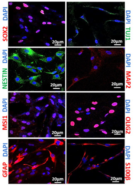JNeurooncol's tweet photo. NSG-70, a novel GSC-enriched cell model, from a patient with recurrent GBM, harbors a unique cytogenetic feature, viz. isochromosome 9q, comprising proneural and mesenchymal subtypes. @DBT_NCCS_Pune 
https://t.co/YcNo1GlsJq https://t.co/BqSdkIzohH