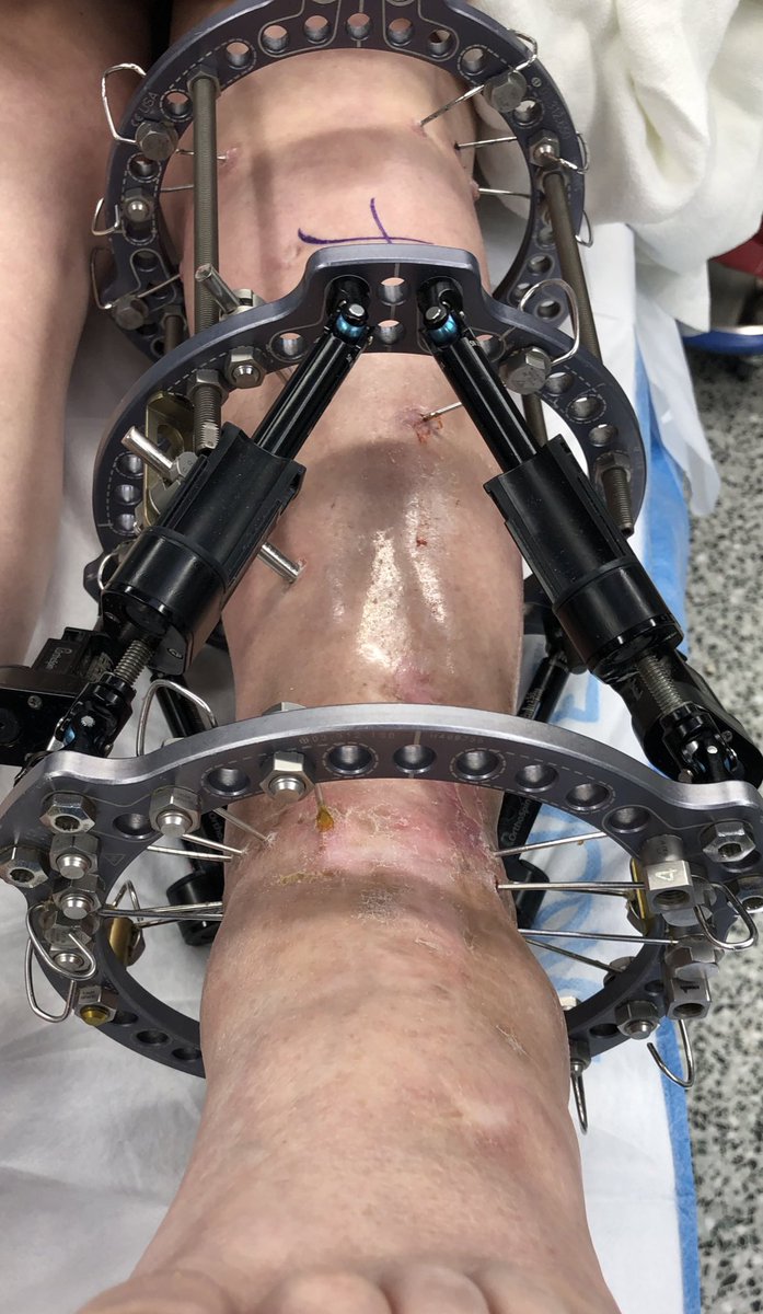 Here is a great example of using a whole lot of wires to stabilize a really stubborn distal tibia non-union in a patient with osteopenia. She is finally healed!