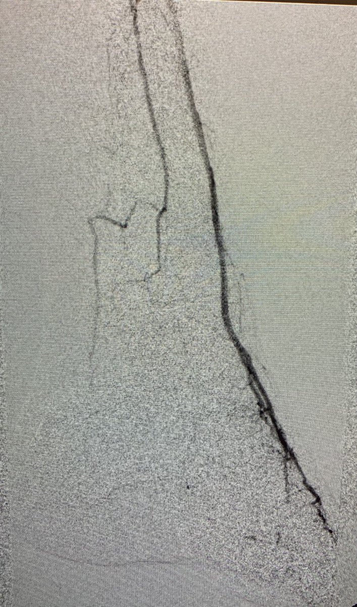 Kuldeep1926's tweet photo. Rest pain in the heel with chronic plantar ulcer. Palpable DP no-palp PT. patient told no other treatment needed, Sent for second opinion. know your #angiosomes @FutureVascSurg #Medtwitter .@VascularSVS @AMPSymposium @_MCLIN_ #vascular @VascularOnline #vascular https://t.co/2tICgPvrX4