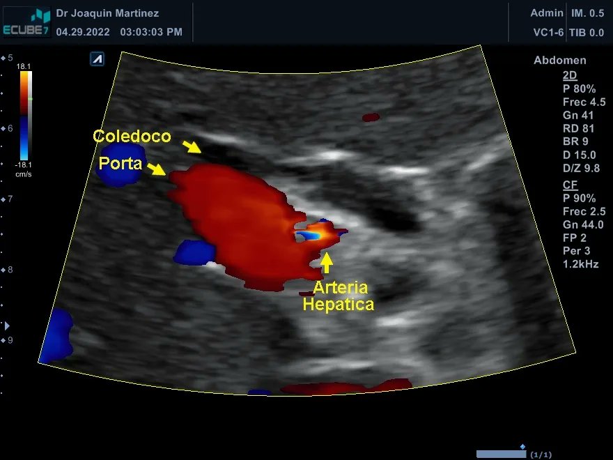 Adenomiomatosis de vesícula biliar. Caso del día. #ultrasound #ultrasonido #sonography