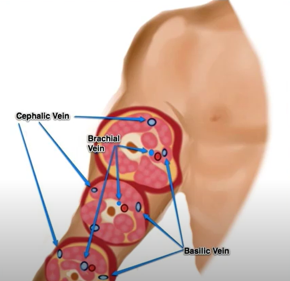 PracticalPOCUS's tweet photo. Why add another step when inserting peripheral IVs? Check out this video on the benefits of POCUS with IVs. https://t.co/LV1MngQS2c
#POCUS #PeripheralIV #bedsideultrasound https://t.co/k8bAQCOriB