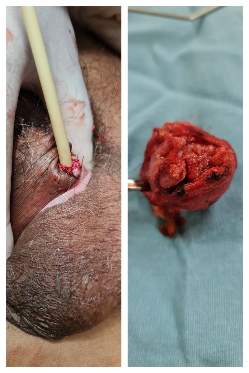 bisturitx's tweet photo. Otra lesión del pene, esta vez tumoral. Colabore con @georgemiccel uro
#cemesa #SoMe4Surgery https://t.co/y7sq7BsH3o