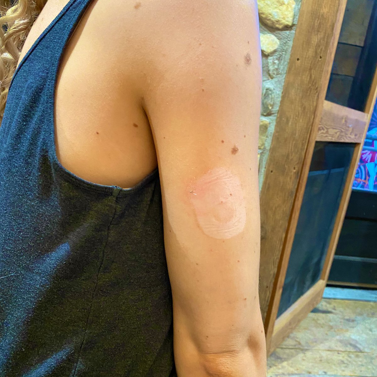 #DexcomTan #DiabetesProbs