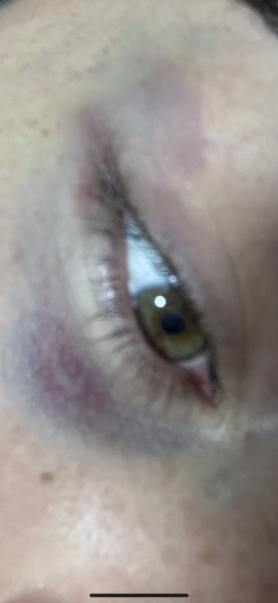 Daddy beat me hard yesterday 😢♥️