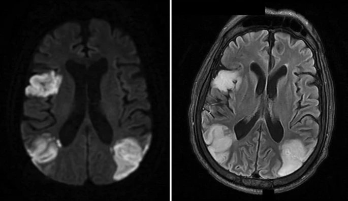 Weill Cornell Neurology (@wcmcneurology) on Twitter photo How is #stroke treated in the #COVID19 era?
Comprehensive review by our residents <a href="/ML_Simonetto/">Marialaura Simonetto</a> <a href="/wechsler_paul/">Paul Wechsler</a> & faculty <a href="/merkler_alex/">Alex Merkler</a>
link.springer.com/article/10.100… How is #stroke treated in the #COVID19 era?
Comprehensive review by our residents <a href="/ML_Simonetto/">Marialaura Simonetto</a> <a href="/wechsler_paul/">Paul Wechsler</a> & faculty <a href="/merkler_alex/">Alex Merkler</a>
link.springer.com/article/10.100…