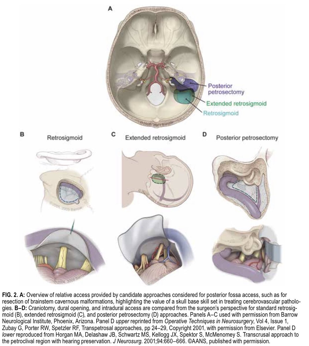 graffeo's tweet image. I'm quite proud of this new paper--a position statement on #ComplexCranial, my unconventional approach to #nsgy training + practice at the nexus of #cerebrovascular + #skullbase, and a meditation on the incredible mentorship of @mtlawton + @MichaelJLinkMD
thejns.org/view/journals/β¦