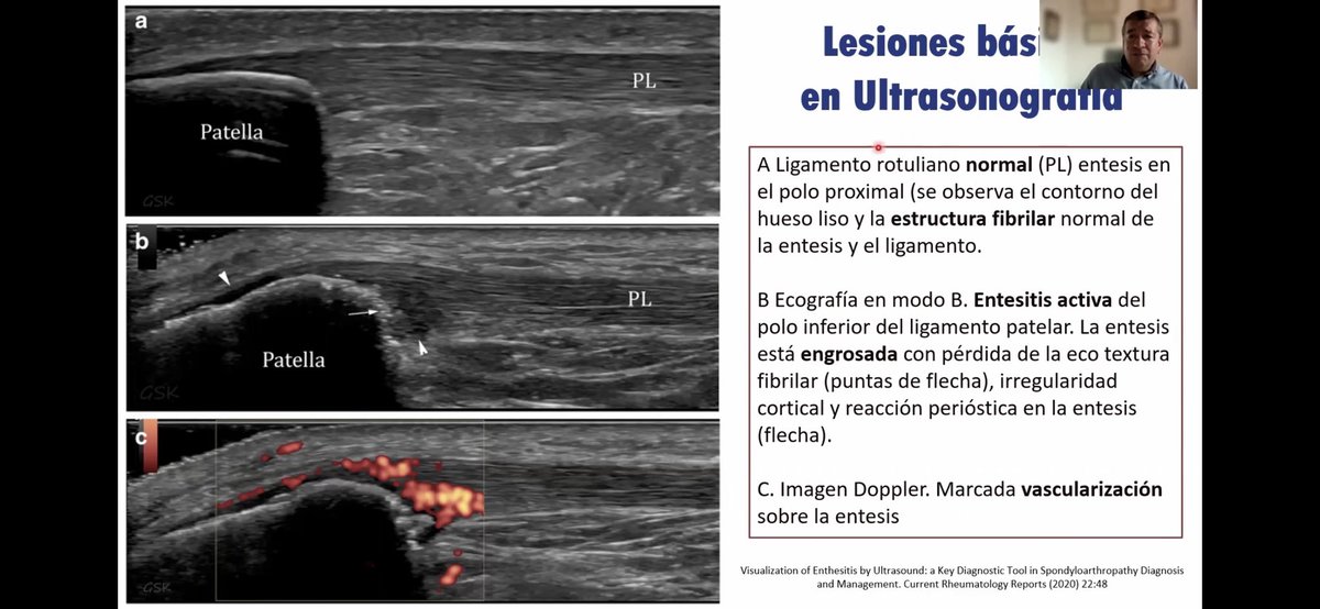mugartegil's tweet photo. Gracias @WilsonBautistaM por tu charla sobre manejo de #entesitis en el curso de actualización de la @soc_peru https://t.co/N3ba22WLK2