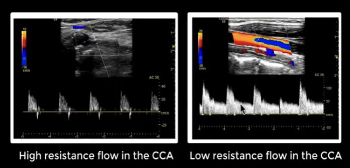 ABCvascular's tweet photo. Intracranial occlusion of the internal carotid artery https://t.co/a6obKpWhgx via @YouTube how to suspect intracranial disease from extracranial carotid Doppler #stroke #Neurology #neurotwitter #carotid #strokecare #radiology @American_Stroke @StrokeAHA_ASA @radiologistpage https://t.co/03AEEF19If