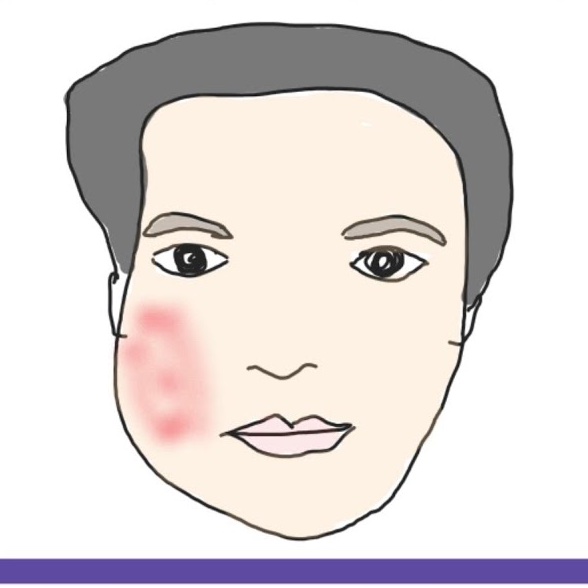xals96's tweet photo. 1/7
ثريد اليوم عن
Buccal Space Infection
وتقع هذه العدوى في
subcutaneous Space between Facial Skin and Buccinator Muscle.
وهي Primary Space ممكن تسببها upper and lower Premolars and molars
و المختلف فيها انها على شكل معين بست اضلاع راح نذكرها الان باذن الله
#Saleh_notes https://t.co/4v5tajEgOo