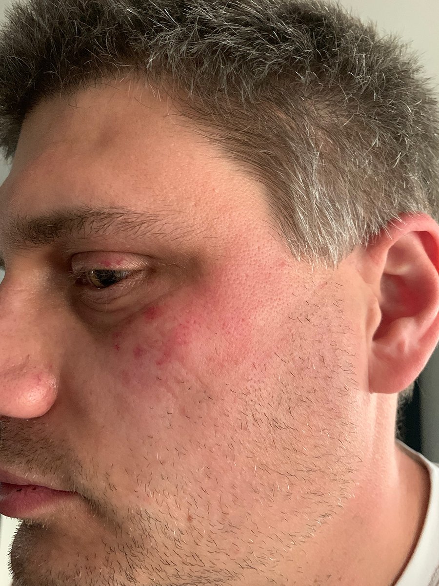 RWKotulski's tweet photo. I was assaulted this morning by an @Uber driver. When I got into the car he refused to take me to the airport unless I paid him cash. So I got out of the car and he followed me out and did this to me. @Uber_Support https://t.co/TahwcWYRO1