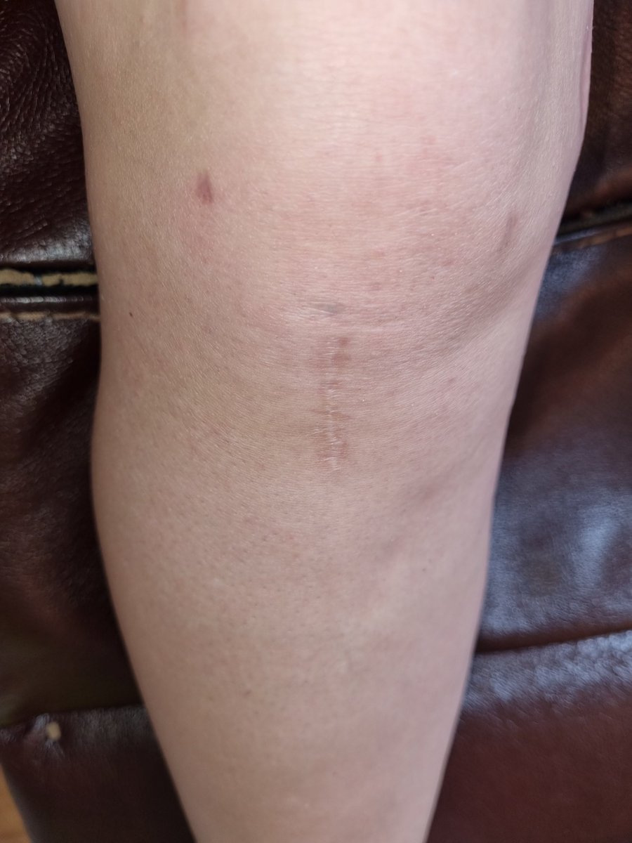 ClionaMackey's tweet photo. 1 year ago today I had full ACL reconstruction followed by 8 months of rehab! Recovery has been fantastic. Thanks to Mr.Ray Moran in @SSCSantry for the fantastic surgery and to Kenny Murphy physio for all his support. Knee healed up nicely #aclreconsruction #patellatendonsurgery https://t.co/5YvAtUAyXa