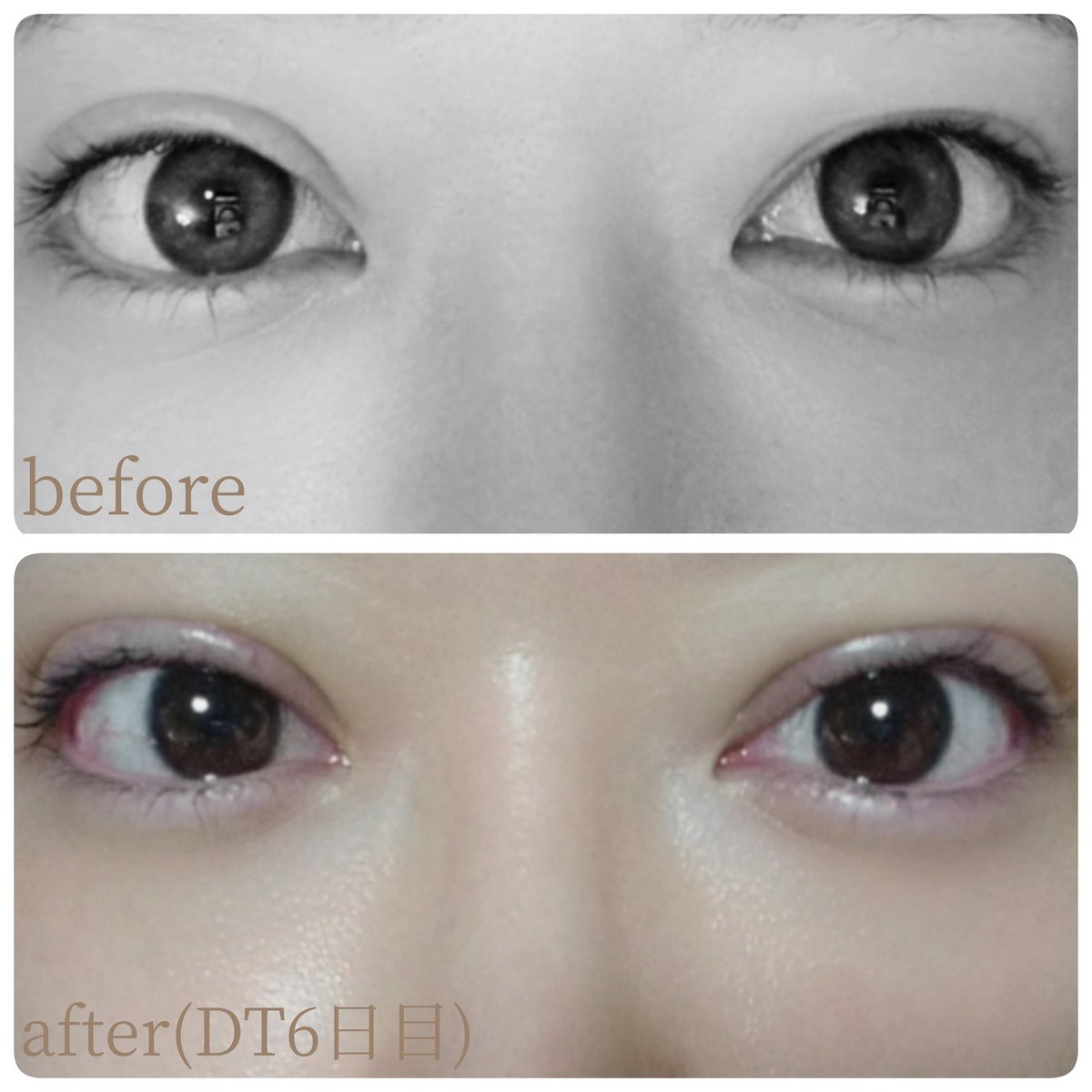 testuser_000's tweet image. 二重切開修正DT7日目🫠
まだ腫れてるけど、左右対象のまま落ち着きそう🙆‍♀️🌷

1回目の切開で
左目は目頭部分の余分な皮膚(○部分)があり…
右目は手術前の二重の線に戻ってしまったのでそこを修正しました🙆‍♀️🌷