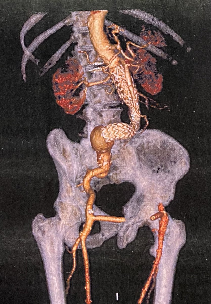 FRuizGrande's tweet photo. EVAR (aorto uni + fem-fem) for AAA in 2012. No endoleaks, excluded. Gradual growth of right iliac aneurysm. Now 57mm, 79yo. Time for open repair. Partial explantation and 14 mm Dacron. Proximal to the endograft and distal to de iliac bifurcation. #inthebucket #aortaed #vascsurg https://t.co/Rp4jqY20Ol