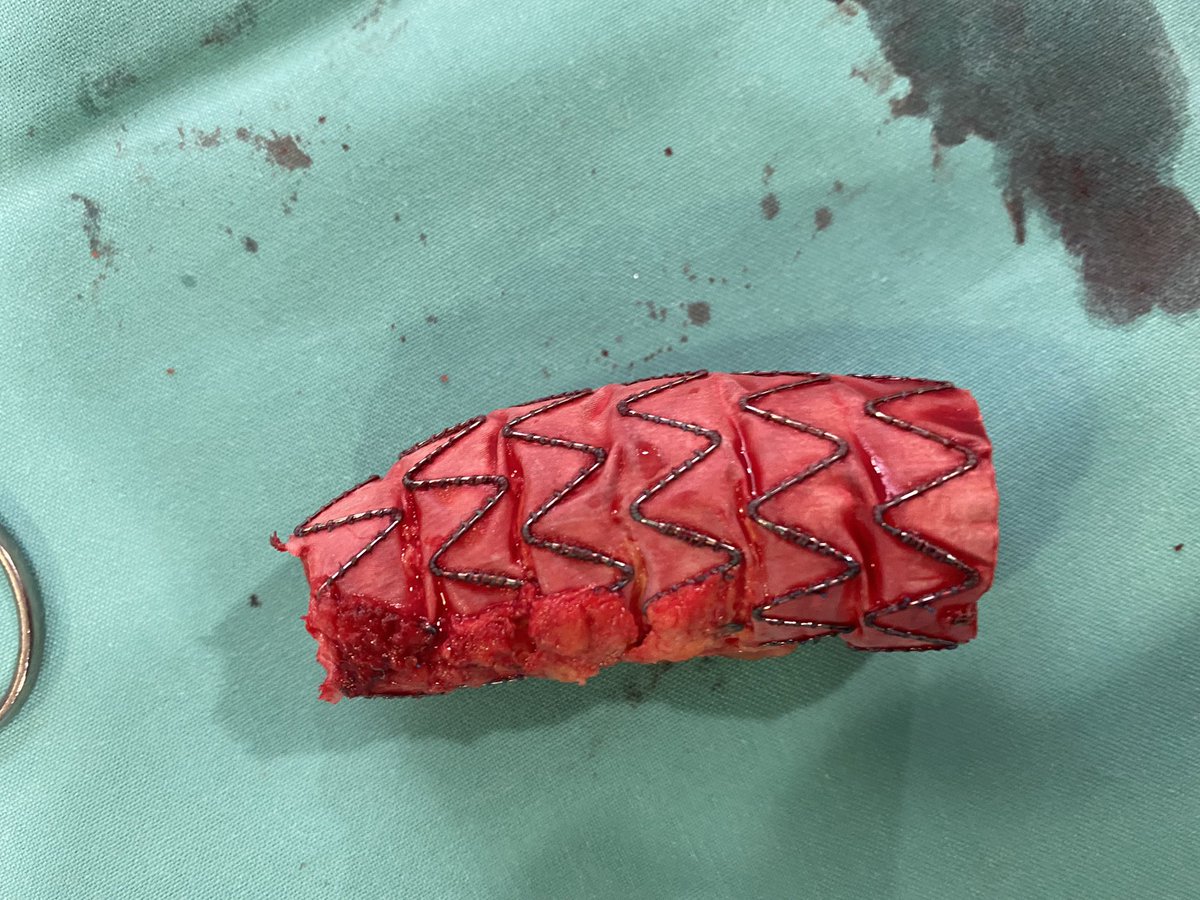 EVAR (aorto uni + fem-fem) for AAA in 2012. No endoleaks, excluded. Gradual growth of right iliac aneurysm. Now 57mm, 79yo. Time for open repair. Partial explantation and 14 mm Dacron. Proximal to the endograft and distal to de iliac bifurcation. #inthebucket #aortaed #vascsurg