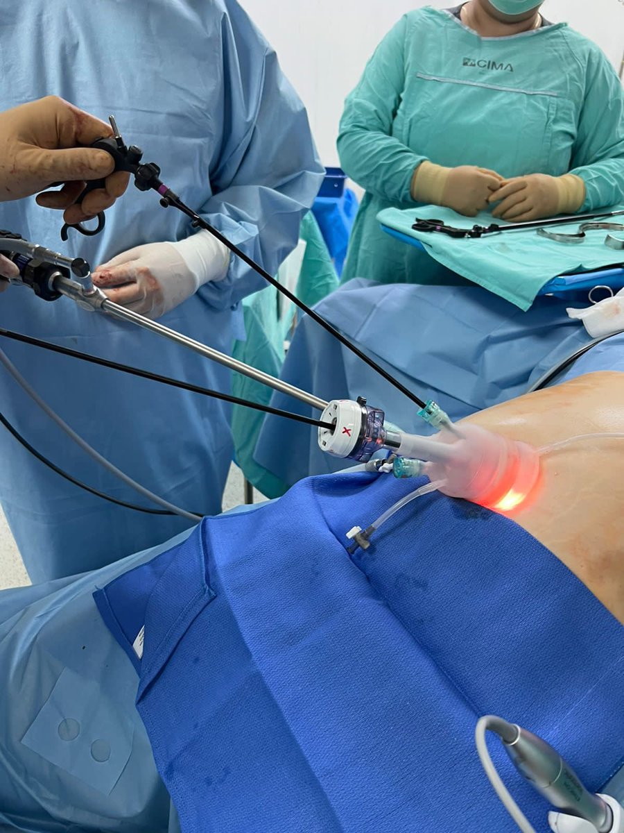gilbertoungson's tweet photo. Sleeve Gastrectomy…. Single port and magnet assisted…
Manga Gástrica apoyado con imanes y puerto único.
@CIMAHMO @ObesidadCMCOEM https://t.co/9YU5CjFS4l