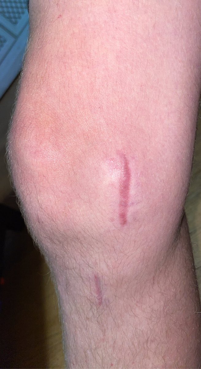 I’m finally released after my MCL surgery! I am very thankful for the recovery I have had so far even though I am not going to be able to participate in contact drills during spring football. Im excited to start regaining the muscle I lost during recovery.