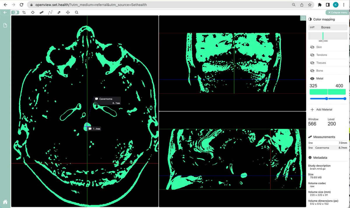 New generation of medical imaging: We leverage technology, has never seen before.
With extremely memory efficient #planar reprojection. ➡️  openview.set.health
 #HealthTech #DevCommunity