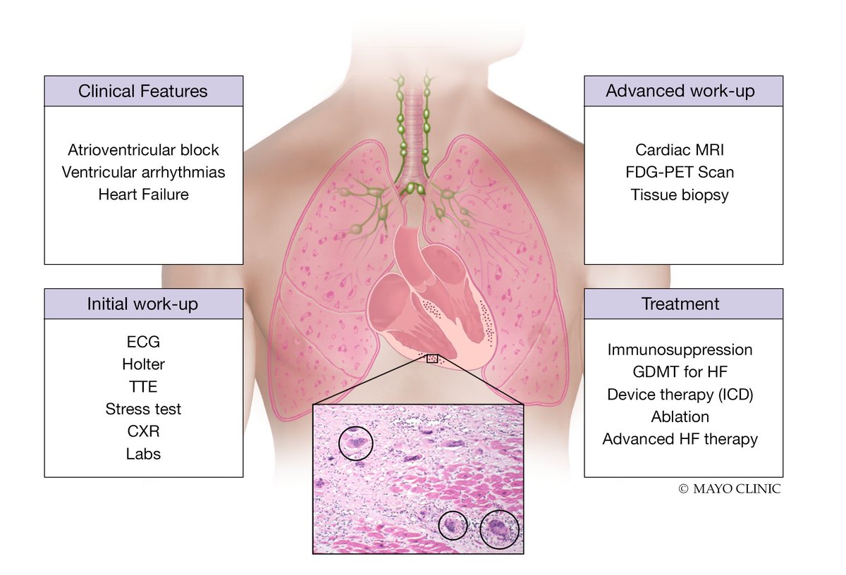 Bryan E. Tan, MD (@bryantanmd) on Twitter photo Hot off the press!! Our State-of-the-art review on Cardiac Sarcoidosis led by my friend & future #EPeeps fellow <a href="/OCTJL/">JL Tan</a> is now published in TCM. Very honored to contribute & extremely grateful for the incredible mentorship by <a href="/DrJustinZLee/">Justin Z Lee</a> <a href="/DrJCheungEP/">Jim Cheung</a> doi.org/10.1016/j.tcm.… Hot off the press!! Our State-of-the-art review on Cardiac Sarcoidosis led by my friend & future #EPeeps fellow <a href="/OCTJL/">JL Tan</a> is now published in TCM. Very honored to contribute & extremely grateful for the incredible mentorship by <a href="/DrJustinZLee/">Justin Z Lee</a> <a href="/DrJCheungEP/">Jim Cheung</a> doi.org/10.1016/j.tcm.…