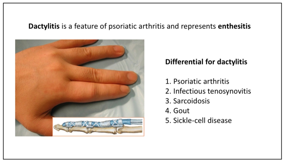 Rheumatologic diagnosis through hand exam by Dr. Sarah Chung @ACPinternists #rheumatology #rheumtwitter #MedEd #rheumatoidarthritis #BJHM #Hospitalmedicine #IM2022 #MedTwitter 👇🏽