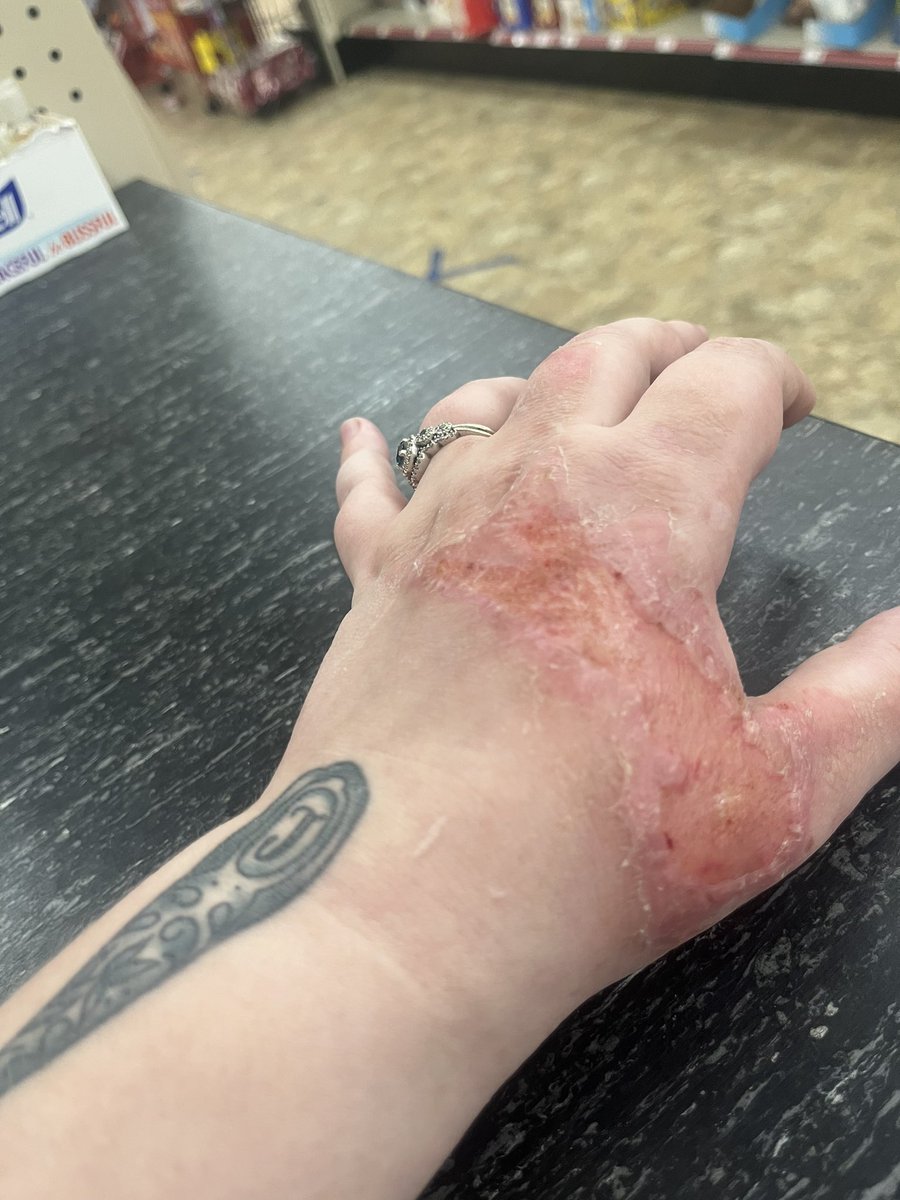 HeatherMerrie's tweet image. The scar I’m going to have 😩