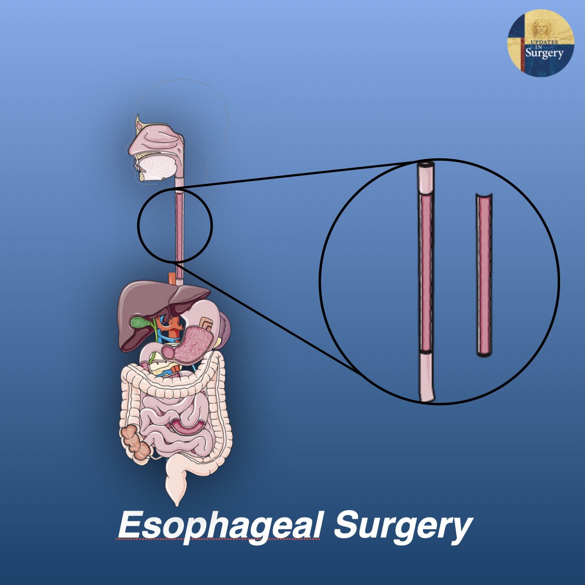 UpdatesSurgery's tweet photo. Minimally invasive esophagectomy reduces mortality and morbidity related to esophageal surgery, but a long learning curve is necessary due to the technical difficulties of thoracoscopy.
Full article: https://t.co/cVssFiggzv https://t.co/StbLU5MUK3