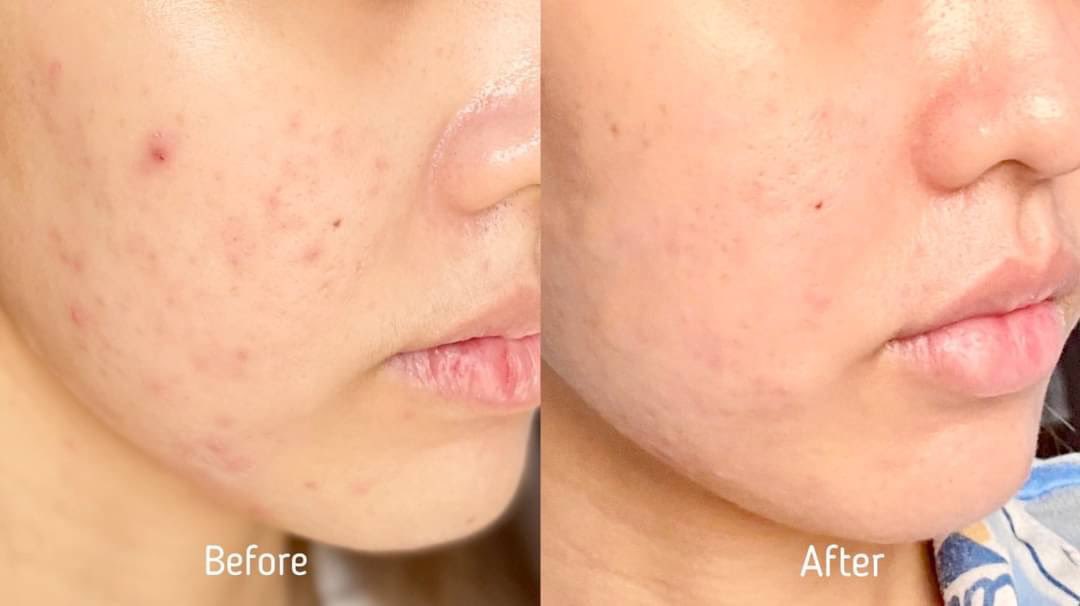 📍เธรดคลีนซิ่งที่ต้องมีติดบ้านสำหรับคนเป็นสิวหรือผิวแพ้ง่าย เพราะเราต้องเลือกให้ถูกกับสภาพผิว! ยกให้ Eucerin เลยตัวแรก pH5 Facial Cleanser ช่วยรักษาสมดุลผิว กักเก็บความชุ่มชื้น สำหรับผิวแพ้ง่าย และ ProACNE Cleansing Gel ทำความสะอาดล้ำลึก ช่วยลดสิวอย่างอ่อนโยน #ใช้จริงรีวิวจริง