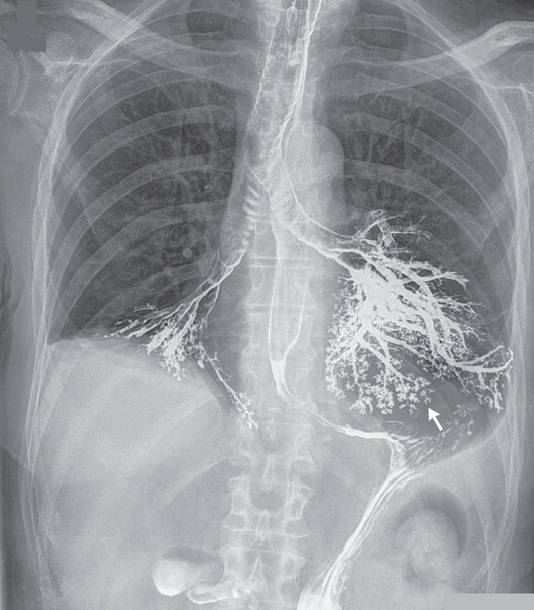 Massive barium aspiration 🤯

#MedTwitter