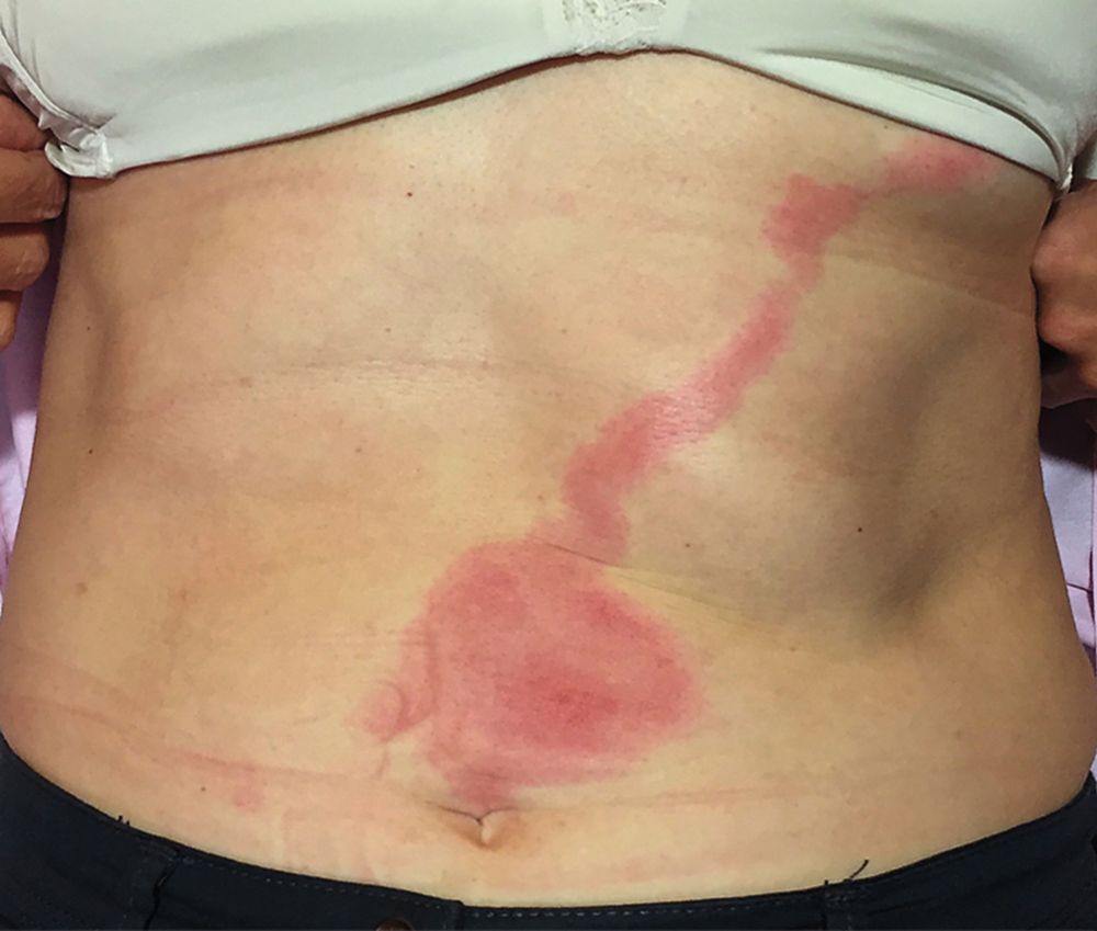 ManualOMedicine's tweet photo. A woman presented with this tender lesion on her abdomen. She improved with antibiotics.
- What is the diagnosis?

👉 Full Case and Answer: https://t.co/Zd24hnVRJQ

#medtwitter #foamed #meded #medicine https://t.co/yBm4jWsJL0