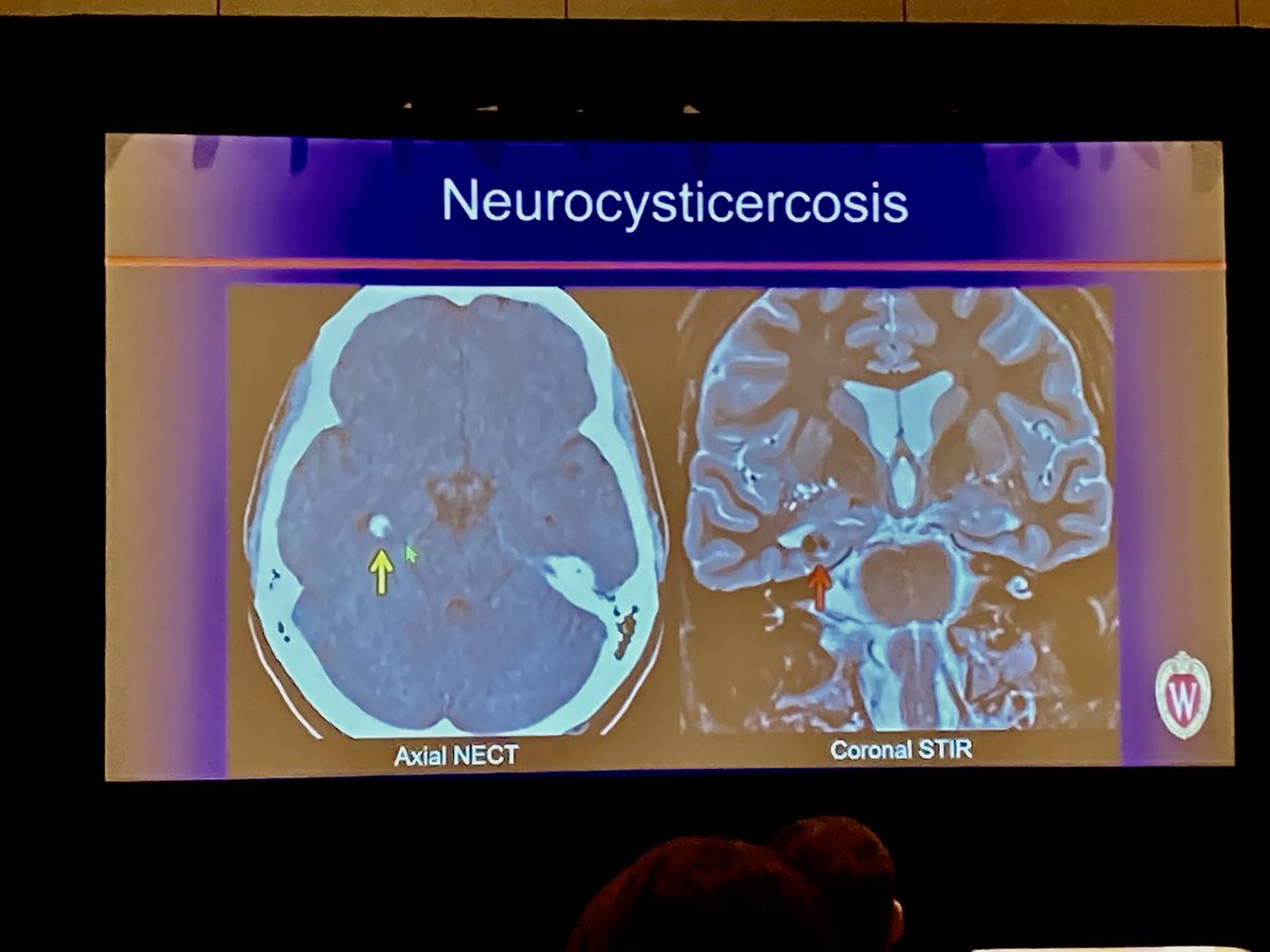 Very complete epilepsy imaging discussion from <a href="/LBEisenmenger/">Laura Eisenmenger, MD</a>! So many things to keep in mind. So good! <a href="/UWiscRadiology/">UW Radiology</a> <a href="/ARRS_Radiology/">ARRS</a>
