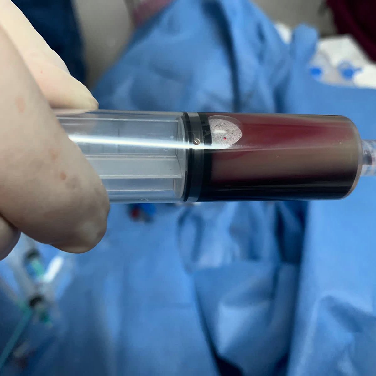 Así se ve una muestra de sangre sin procesar, en un paciente con triglicéridos &gt;2000 mg/dL.