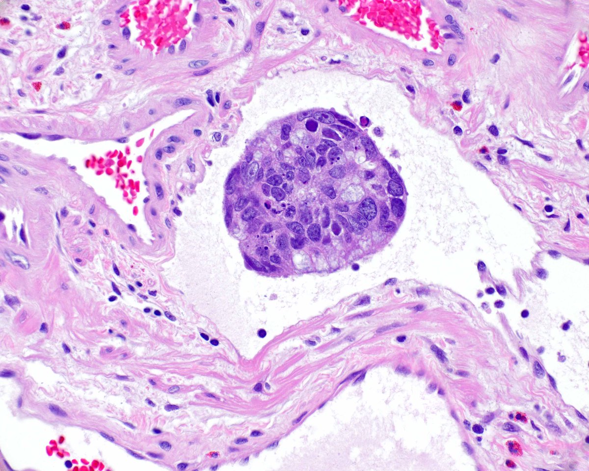 This is simply an amazing example of lymphatic space invasion "caught in the act" in what appears to be intramucosal (muscularis mucosae invasion) carcinoma in a colorectal polypectomy sample.  Of course there might be submucosal invasion that simply is not apparent on the slide.
