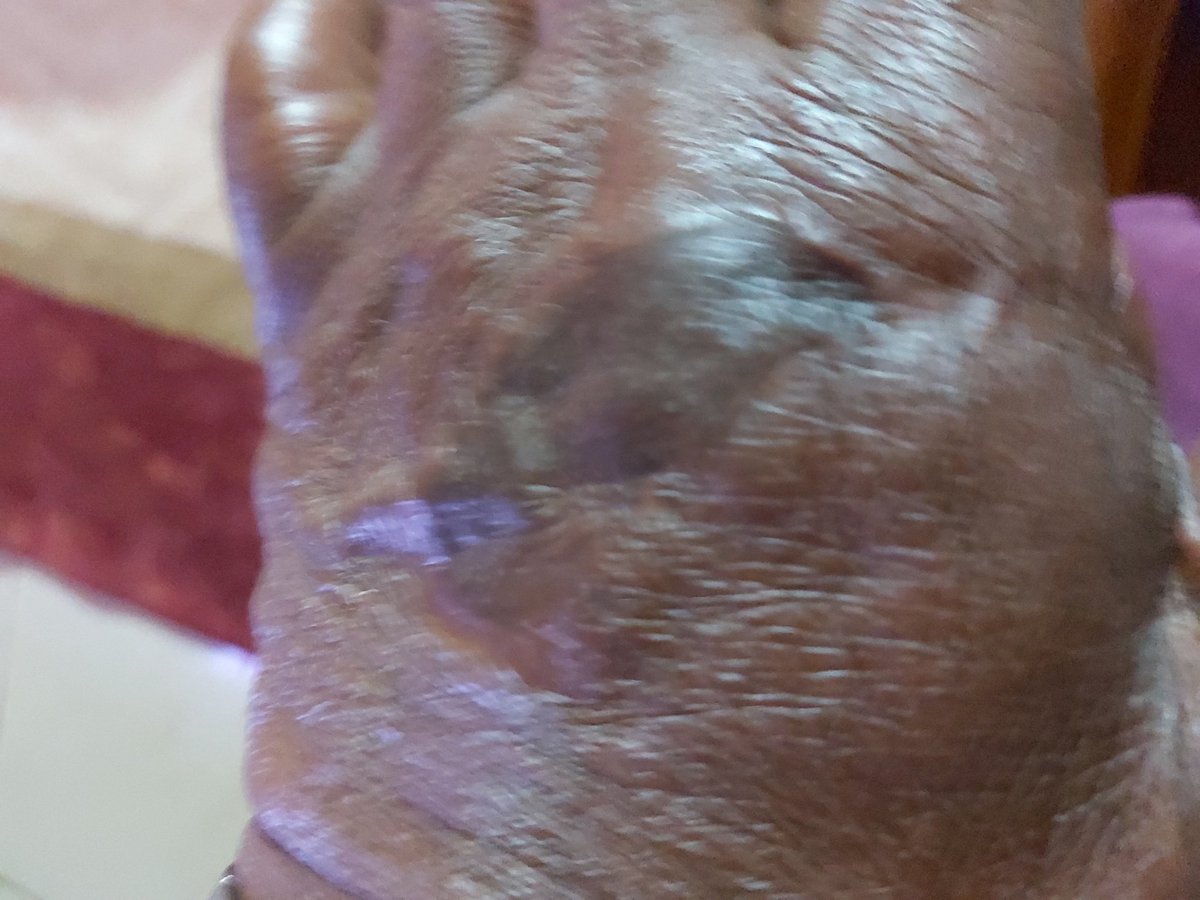 timothynjoya's tweet image. Today is 45th anniversary since labour day 1977 when under the Kenyatta regime 9 policemen visited  my house, chopped off my three fingers, injured my whole body and left me for dead. That morning I had preached that Harambee is the Ideology of the Kikuyu middleclass.