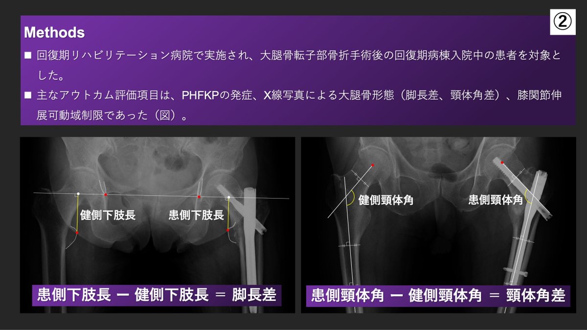 copellist's tweet image. 大腿骨近位部骨折後に膝関節疼痛(PHFKP)を発生する患者さん、いませんか？
PHFKP発症の予測因子とカットオフ値を明らかにした論文がPM&amp;amp;R Journalにて公開されました✨
カットオフ値は、簡便に計測でき、有用と思われます😊
是非ご一読ください🌸
🔗 doi.org/10.1002/pmrj.1…
#拡散希望 🙇 #PMRJournal