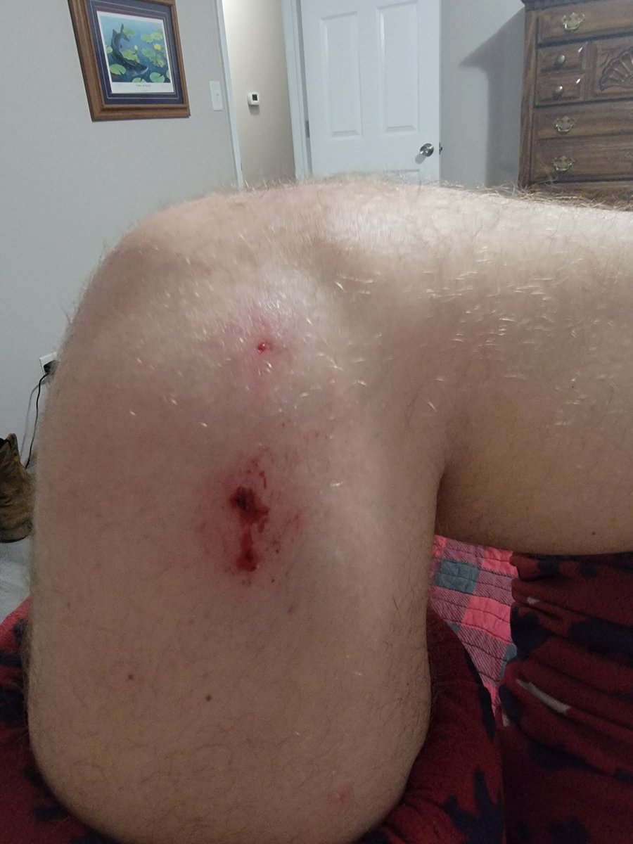 Got bit by a dog out for a run tonight. Good times. #runner #running #fitness #dogs