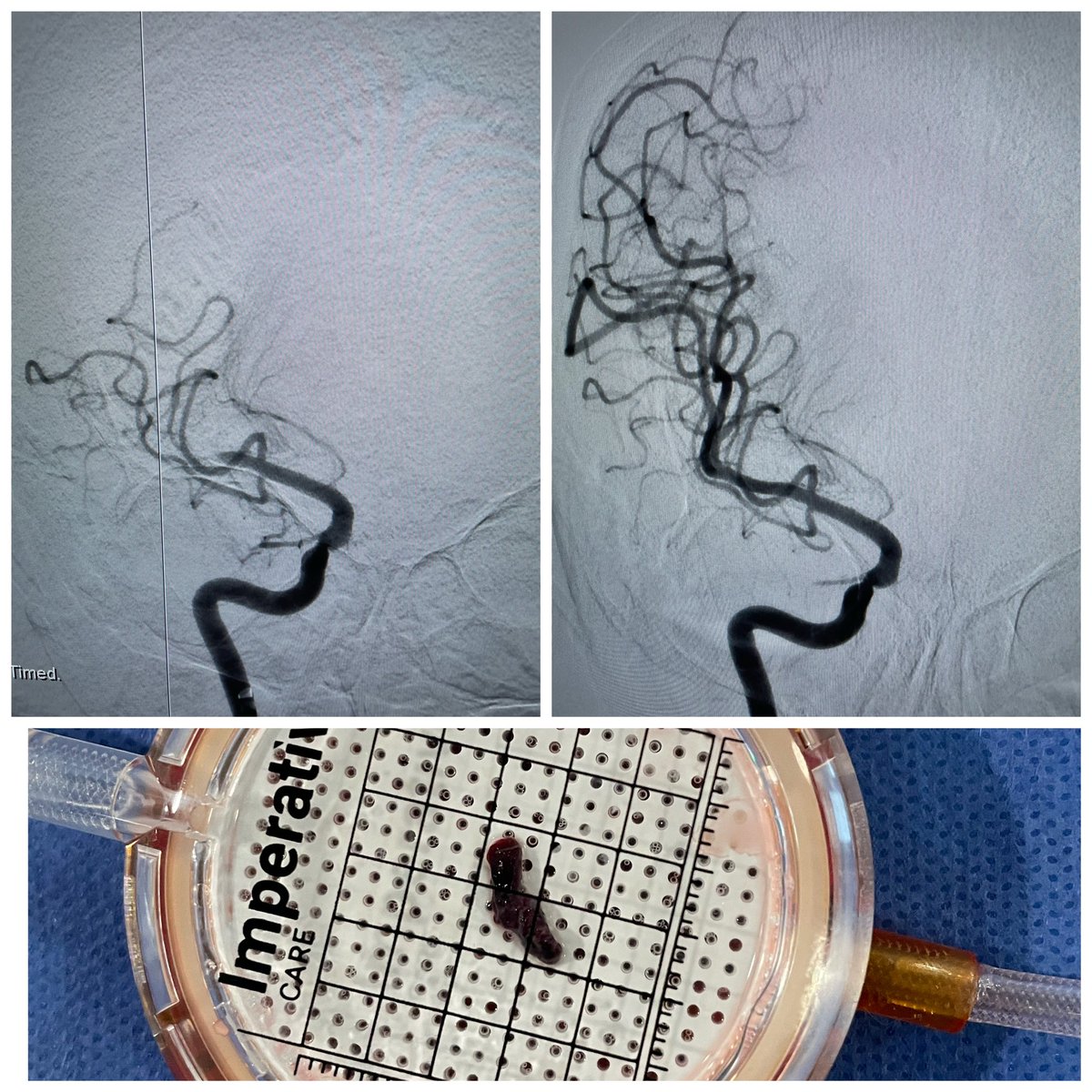 Shahram Majidi, MD (@majidishahram) on Twitter photo 10-minute thrombectomy is not a breaking news anymore but a new norm #justZoomIt #nowire #noMicrocath #snake #stroke @imperative_care <a href="/MountSinaiNeuro/">Mount Sinai Neurosurgery</a> <a href="/MtSinaiQueens/">Mount Sinai Queens</a> with <a href="/Mais_Alk/">Mais Al-Kawaz</a> 10-minute thrombectomy is not a breaking news anymore but a new norm #justZoomIt #nowire #noMicrocath #snake #stroke @imperative_care <a href="/MountSinaiNeuro/">Mount Sinai Neurosurgery</a> <a href="/MtSinaiQueens/">Mount Sinai Queens</a> with <a href="/Mais_Alk/">Mais Al-Kawaz</a>