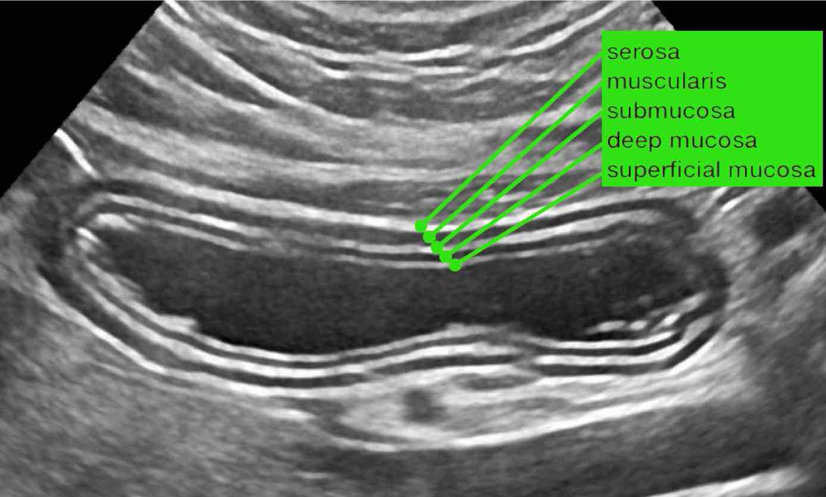 Intestinal Ultrasound #GITwitter #MedEd We will start with normal Normal #IUS #anatomy