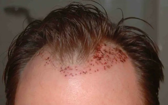 Hairloss Experiences on Twitter: Hairloss Experiences on Twitter:
