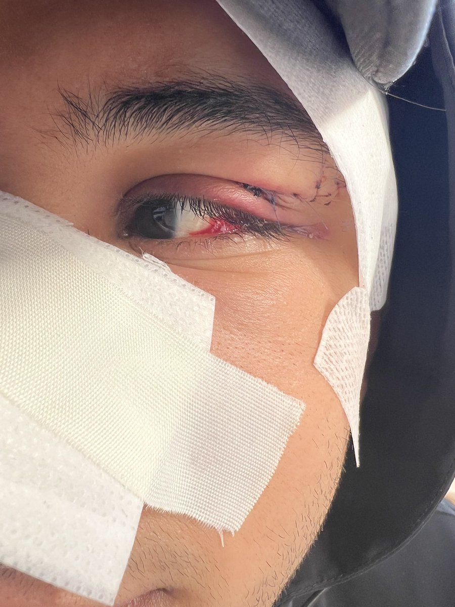 AhmedTahseen10's tweet photo. حسبي الله ونعم الوكيل،محدش فاهم ايه اللي حصل وزي ما باين في الڤيديو أحمد واقف لا بيه ولا عليه بيلعب ع التليفون مع عيل صغير واحد دخل عوره في وشه وطلع يجري بدون سبب، احمد احتاج ٢٤ غرزة والله اعلم بعد العلاج هيرجع تاني زي الاول ولا لأ والبيه هربان ومحدش عارف يوصله.
#حق_احمد_الحضري https://t.co/h07YVuRAY2