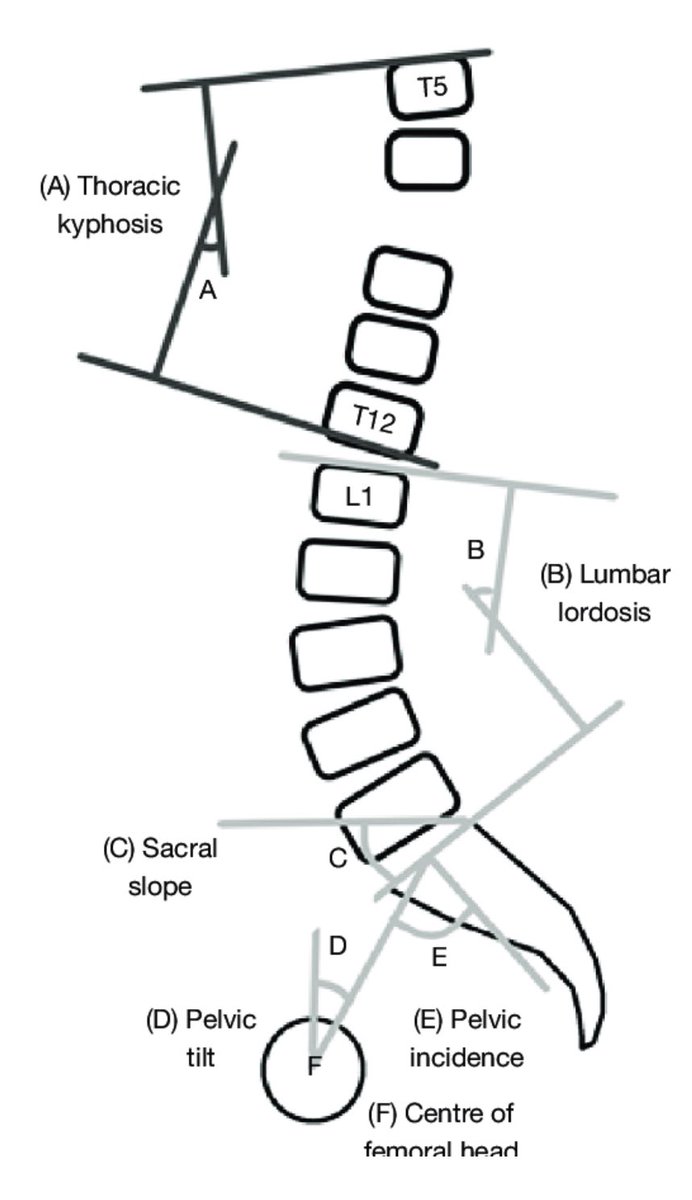 OGdukeneurosurg's tweet photo. Do Not Build a Flatback! Maintain and restore spinopelvic balance. Lordosis is good. Flat is bad. PI - LL < 10 is good. #spine #knowyourparameters https://t.co/ttr7L42eFj