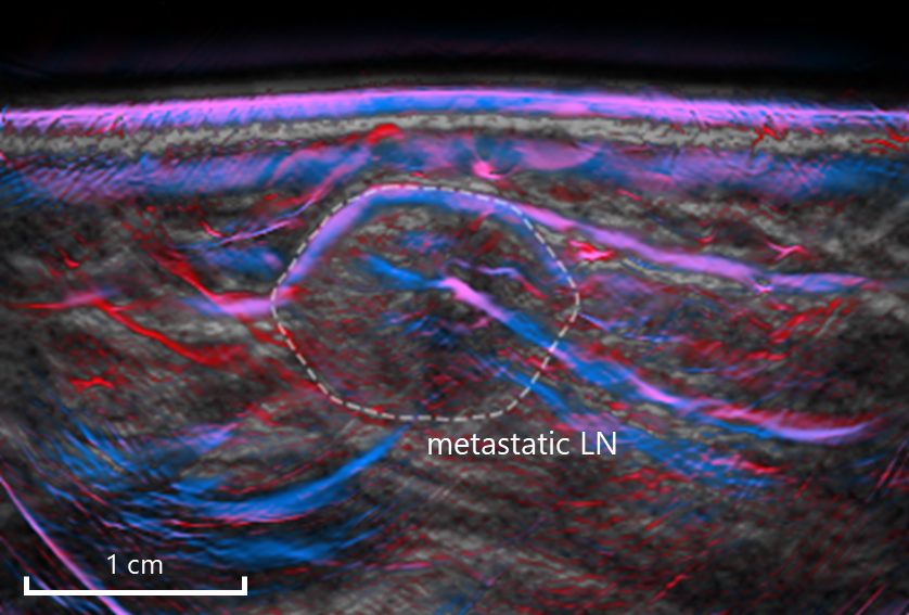 kukacka_jan's tweet photo. Our new paper on optoacoustic imaging of metastatic cervical lymph nodes is out! High-resolution handheld #MSOT showing again its capabilities on an interesting clinical problem. Great collaboration with @JasperVonk and the teams on both sides @MunichImaging &amp; UMCG https://t.co/XLFJMrDMVz