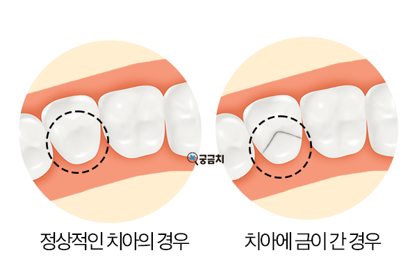 ggchi_info's tweet photo. 궁금치의 칼럼, "치아에 금이 가는 치아균열증후군에 대해서"이 올라왔습니다!🦷✨

https://t.co/LSHxgp31zF https://t.co/6uhBXEfNNG