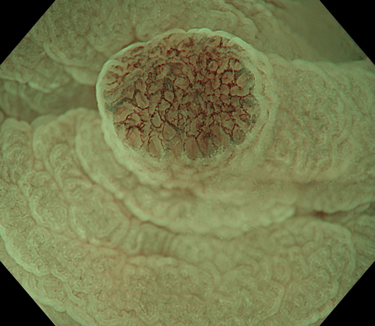 Serhii_endo108's tweet photo. Optical diagnosis:
Location - sigmoid colon
Size - 2mm
Morphology - 0-IIa
Pit pattern - IIIL
NBI - JNET 2A
Treatment - cold snare polypectomy (CSP)
#colonoscopy #opticaldiagnosis #zoomscope https://t.co/qgLbi7wKvS