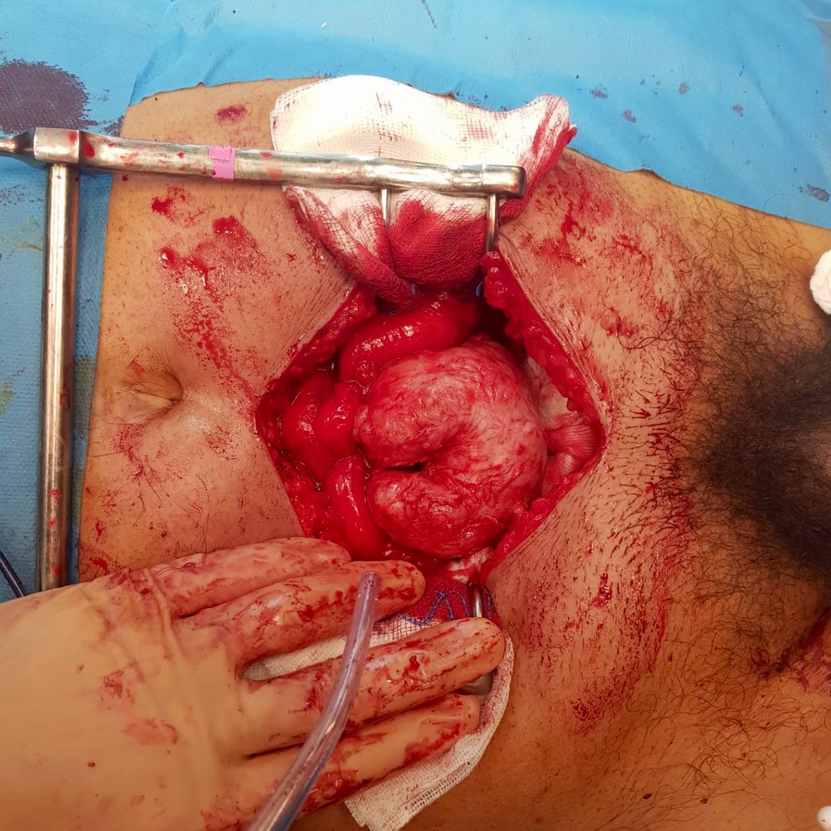 Urology_Fadi's tweet photo. What a surgery to start your week!
204cc open #prostatectomy #millin technique, removed in one piece.
Blood loss 🩸 < 300cc!
#surgtweet #medtweet #urology #surgery
🏥 @ChuSaintPierre 🇧🇪 https://t.co/NjJrHHofeY