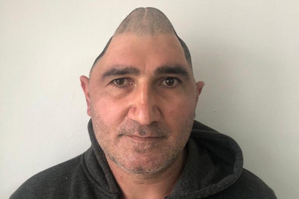 bpthaber's tweet photo. İstanbul’da evinin penceresinden düşerek kafatasının yüzde 83'ü parçalanan 45 yaşındaki Ali Çiftçi, 3 boyutlu yazıcılarla hazırlanan implantlar sayesinde eski görüntüsüne kavuştu. https://t.co/0MzKfTHH8S