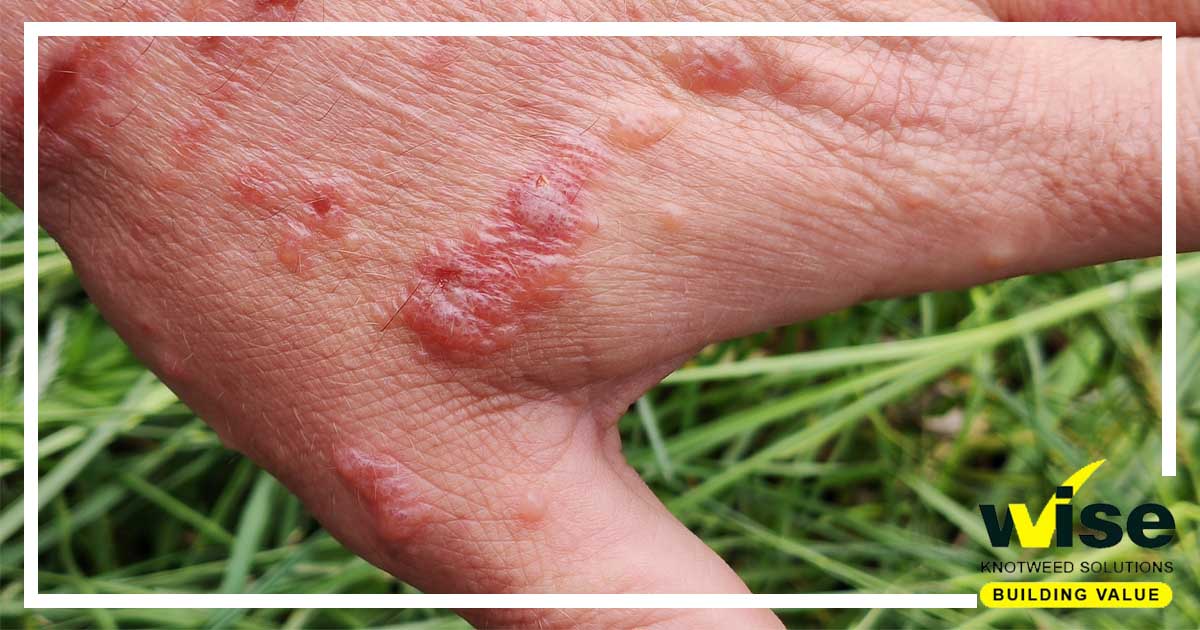 It is worth being aware that coming into contact with the sap of Giant Hogweed can cause serious burns, blisters and potentially blindness. To discuss the professional removal of Giant Hogweed contact Wise Knotweed Solutions today.