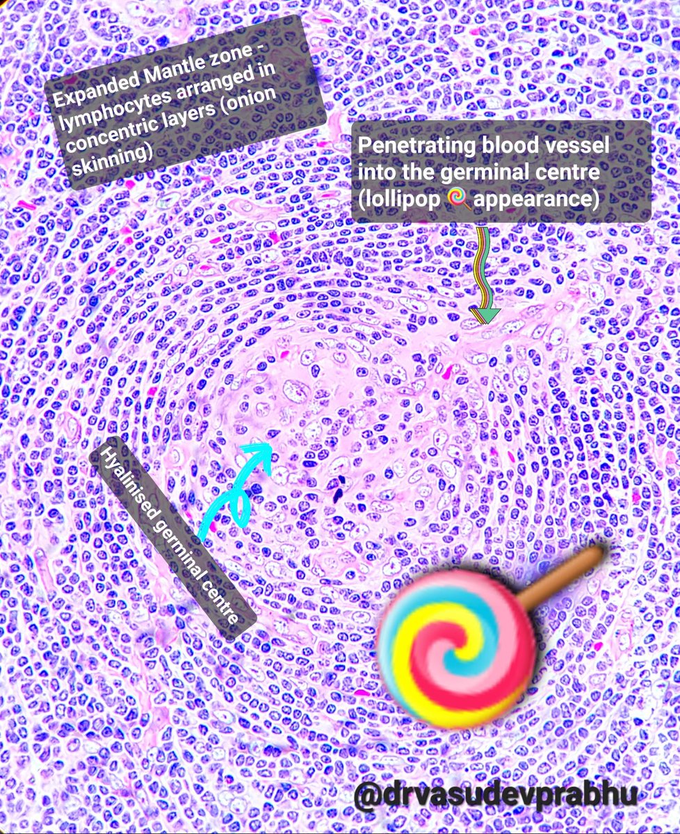 For the all resident friends and teaching enthusiasts 🍭 #pathboards #pathspotters #PathTwitter #pathresidents #histopathology <a href="/DrApoorvaN1/">Apoorva N</a> <a href="/anjuthevirgo/">Anju Pandey</a>